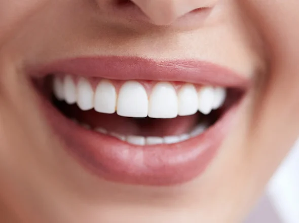 sta je hollywood smile