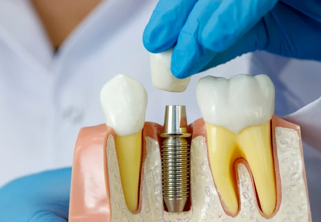 proces postavljanja navlaka na implant