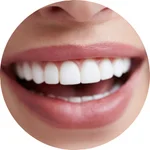 Hollywood smile cena beograd